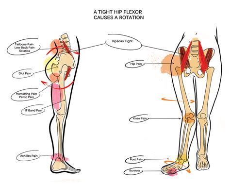 Hip Flexor Pain Causes