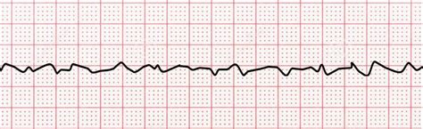 The Difference Between Ventricular Tachycardia and Ventricular ...