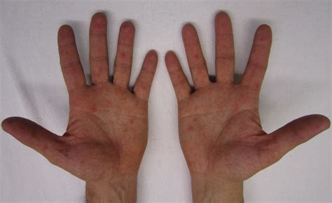 File:Characteristic rash of hand, foot, and mouth disease, on human ...