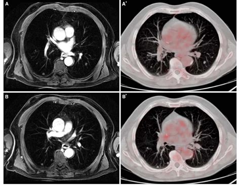 Fifty-nine years-old patient with multiple lung metastases 4 years ...