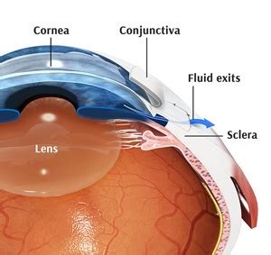 Glaucoma Surgery St. Leonards | Laser Treatment | Vision Loss North Shore