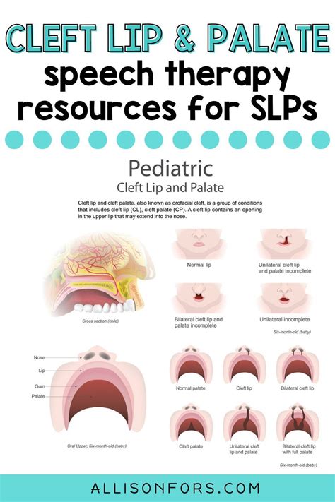 Speech therapy information about cleft palate and cleft lip. Discover ...