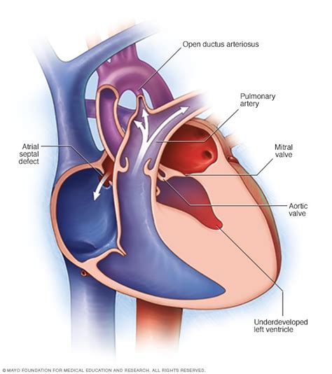 Hypoplastic left heart syndrome - Symptoms and causes - Mayo Clinic