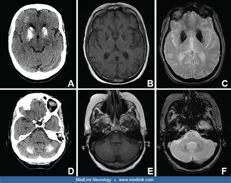 scib1 | MedLink Neurology