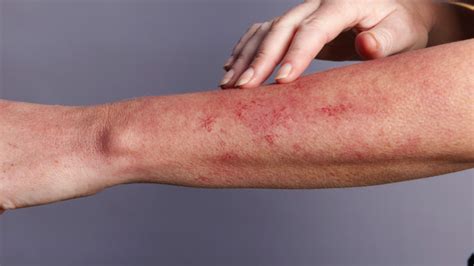 pictures of lyme disease rashes - pictures, photos