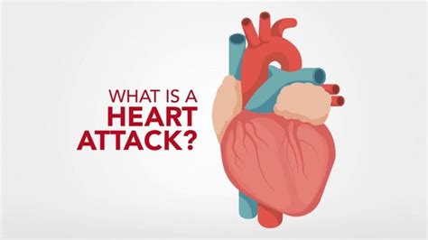 What is a Heart Attack?: Premier Cardiovascular Consultants: