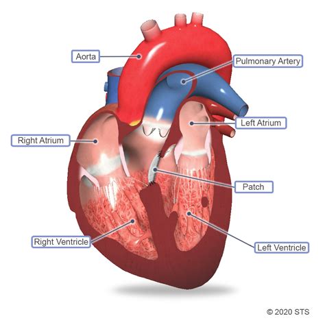 Ventricular Septal Defect Surgery | The Patient Guide to Heart, Lung ...