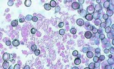 Blastomycosis Archives - www.medicoapps.org