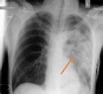 Chest Tube Complications and How to Fix Them - County EM - Trauma