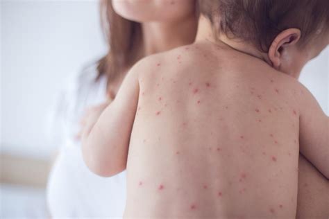 Measles, Mumps, Rubella: What is the MMR Vaccine?