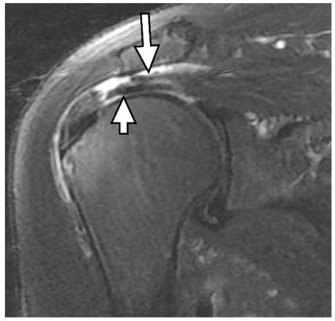 Diagnostics | Free Full-Text | Delaminated Tears of the Rotator Cuff ...