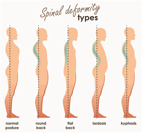 Loss Of Lumbar Lordosis