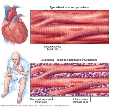 Miocarditis - Síntomas y causas - Mayo Clinic