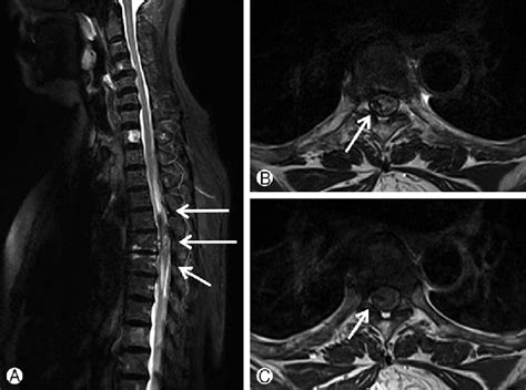 Initial Magnetic resonance imaging (MRI) of the thoracic spine ...