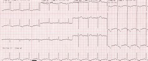 Left ventricular hypertrophy (LVH) with strain pattern