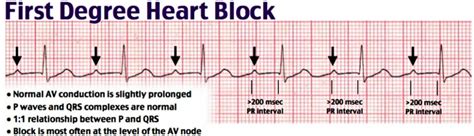 Heart block causes, symptoms, types, diagnosis and heart block treatment