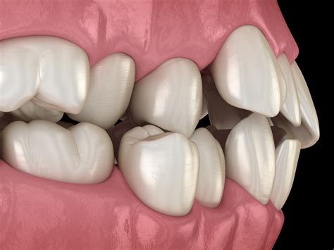 What Causes Protruding Teeth in Adults?