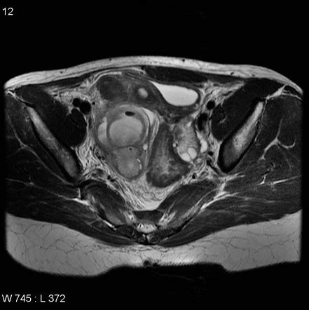 Tubo Ovarian Abscess Histology