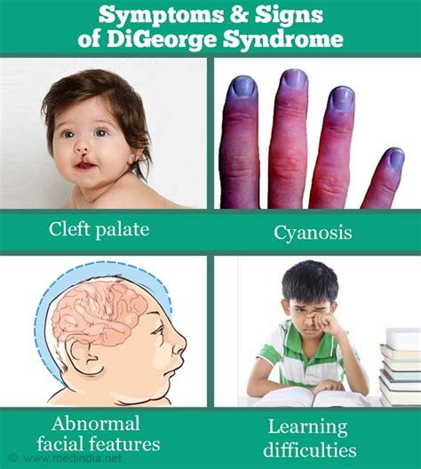 DiGeorge Syndrome - Causes, Symptoms, Diagnosis, Treatment & Prognosis