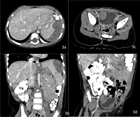 -(a and b) CECT abdomen at recurrence Axial + Coronal images showing ...