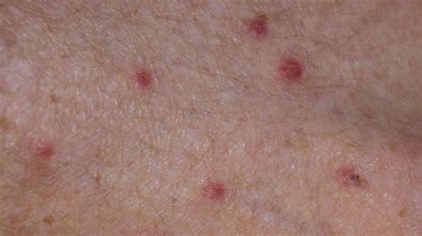 Scabies Vs. Bed Bugs: Identification and Treatment