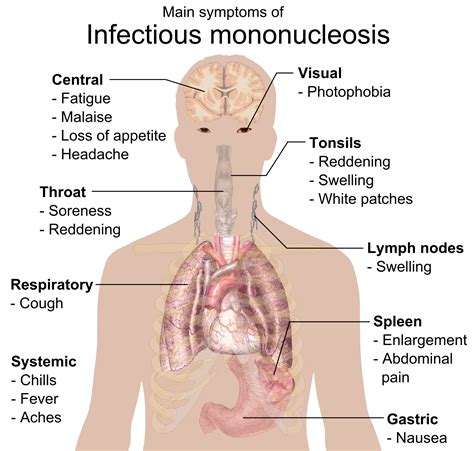 File:Main symptoms of Infectious mononucleosis.png - Wikipedia, the ...