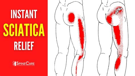 How to Instantly Fix Sciatica Pain - YouTube