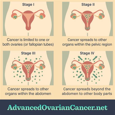 What Are The Stages Of Ovarian Cancer?