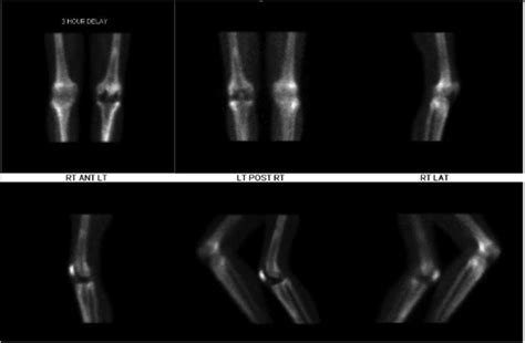 Triple phase bone scan demonstrating mild-to-moderate increased uptake ...