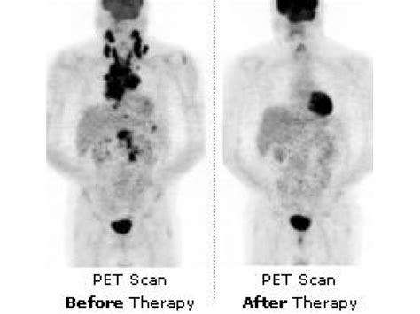 CANCER 101: PET SCANS | East Brunswick, NJ Patch