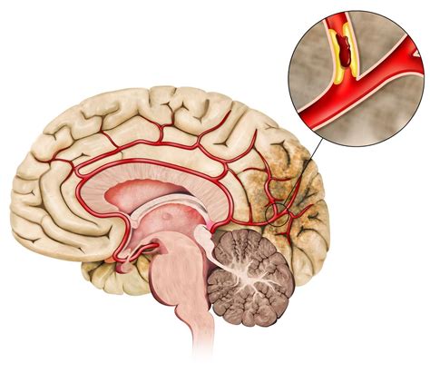 brain cerebral infarction | Bull art, Medical illustration, Map art