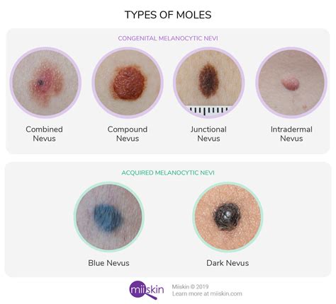 Moles (Nevi) Guide | Types & Pictures of Normal Healthy Moles