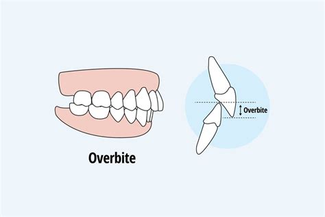 Overbite vs Normal Bite: Differences, Causes, and Treatment