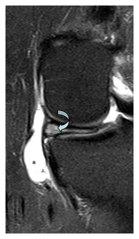 MRI and ultrasound demonstrate the meniscal cyst: (a) coronal ...