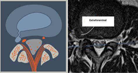 Cureus | Anatomic Image-Based Classification of Lumbar Intervertebral ...