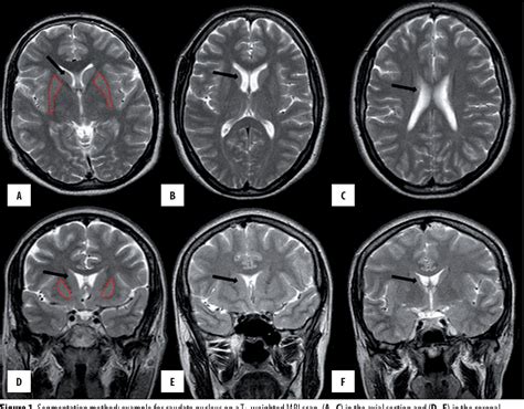 Caudate Nucleus Mri