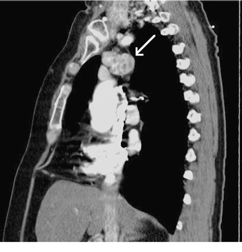 Figure 3 from Ectopic thyroid tissue in the anterior mediastinum with a ...