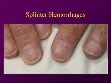 What is Splinter Hemorrhage? Causes, Symptoms, Risks, Treatment