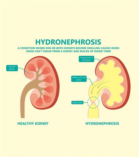 Hydronephrosis In Babies: Causes, Symptoms, And Treatment – AbooBaby.com