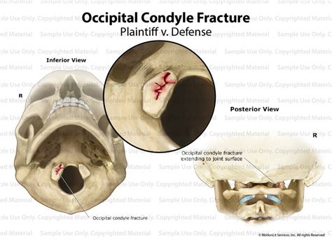 Occipital Condyle Fracture - MotionLit