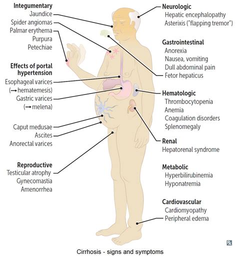 Cirrhosis Symptoms