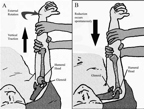 Shoulder - Crashing Patient