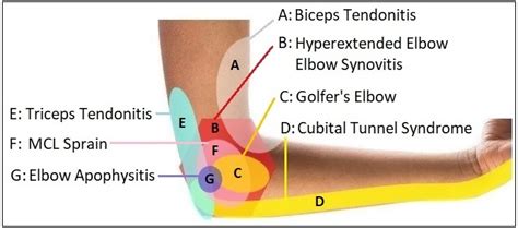 Elbow Pain Diagram: Diagnosis Chart