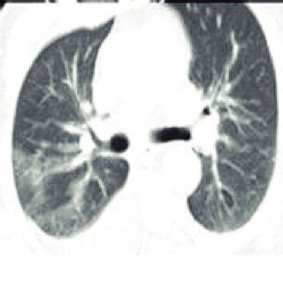 Brain CT scan image of the 1 st case. Figure 2: Chest CT scan image of ...