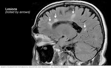 MRI multiple sclerosis lesions - Mayo Clinic