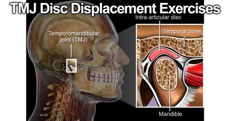 TMJ Disc Displacement Exercises – JawFlex®