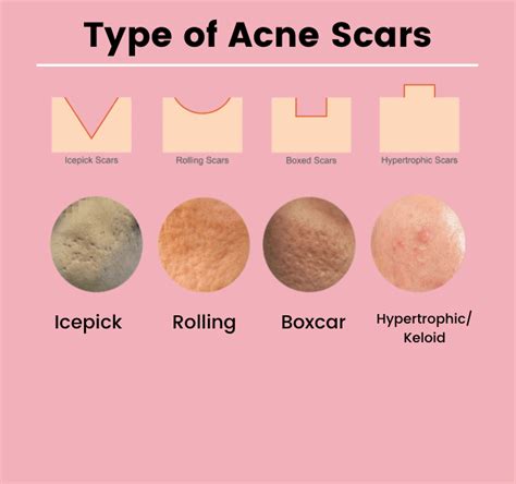 Acne scars. Types and treatments - Hush LA Medspa