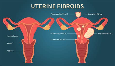 Small Fibroid In Uterus Presentation