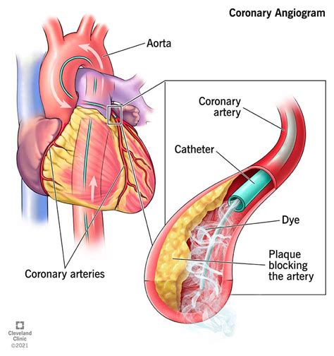 Coronary Angiogram: Procedure Details