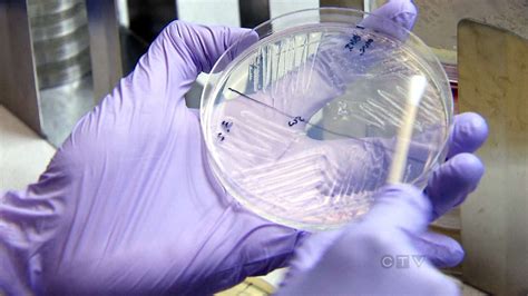 Health Canada willing to ease fecal transplant rules for recurrent C ...